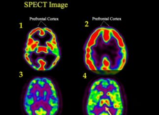 Un estudio de la UPV/EHU ayudará a rastrear la enfermedad de Alzheimer
